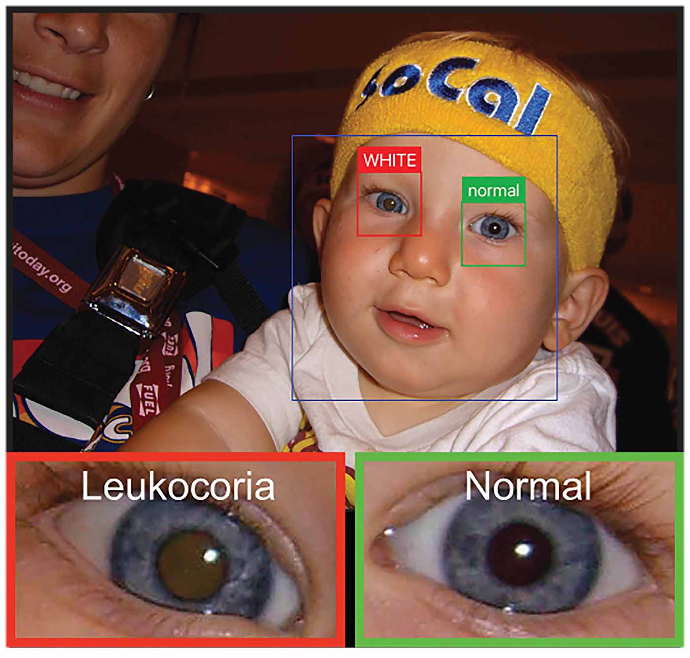A Phone App That Can Detect Eye Disease In Kids
